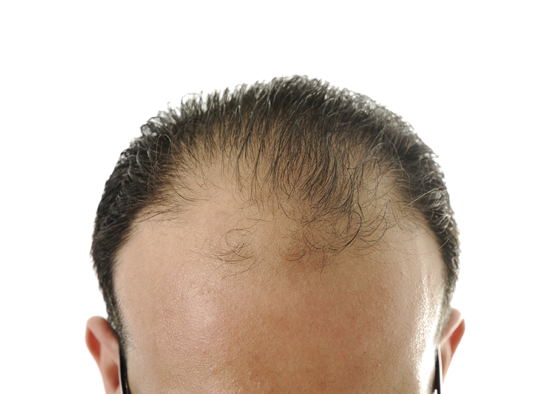 Fluch oder Segen: Haarwuchsmittel auf dem Prüfstand